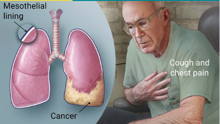 Mesothelioma-2